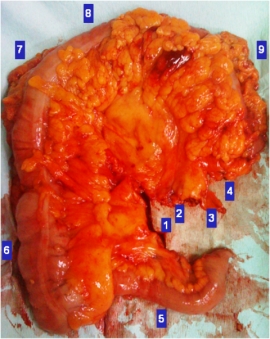 Αρχές χειρουργικής εκτομής  του καρκίνου του παχέος εντέρου